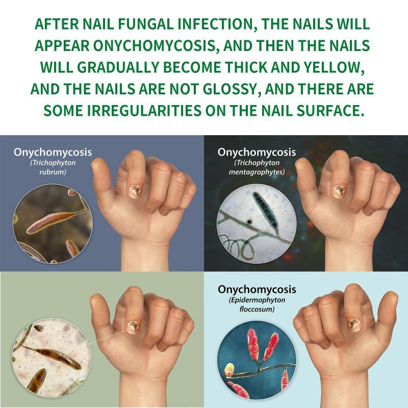 7 Day Ginger Nail Treatment.