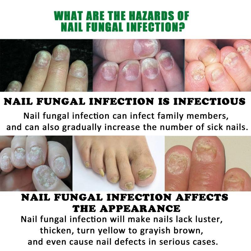 7 Day Ginger Nail Treatment.