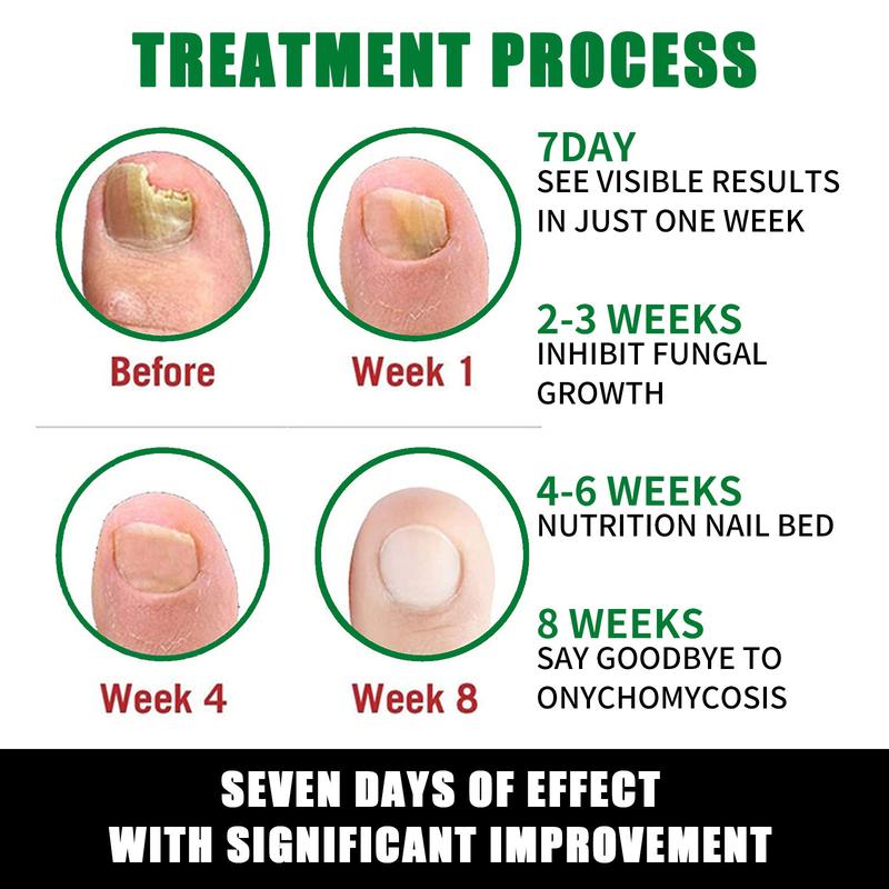 7 Day Ginger Nail Treatment.